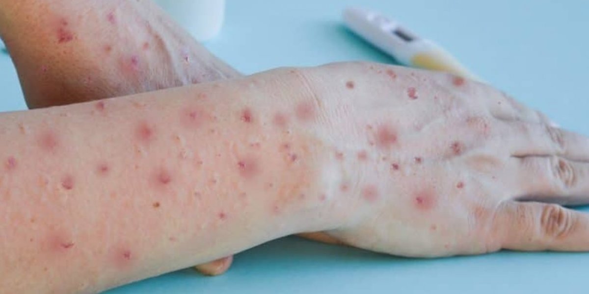 6º Caso de óbito por Varíola dos Macacos é confirmado no Brasil