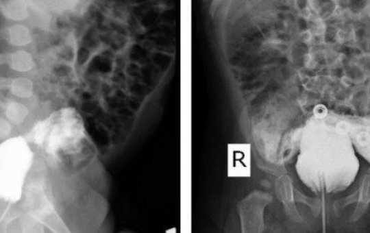 Bebê no Irã surpreende ao nascer sem pênis e urinar pelo ânus