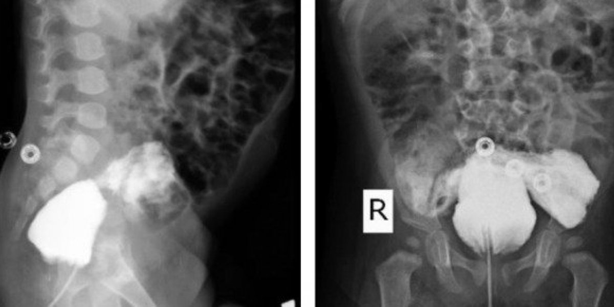 Bebê no Irã surpreende ao nascer sem pênis e urinar pelo ânus