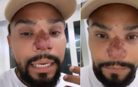 Naldo toma viagra para tratar nariz e afirma: "Está indo na parede, no teto"