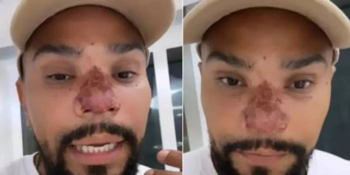 Naldo toma viagra para tratar nariz e afirma: "Está indo na parede, no teto"