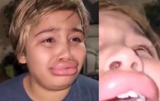Criança faz preenchimento labial caseiro e viraliza ao cair no choro; veja