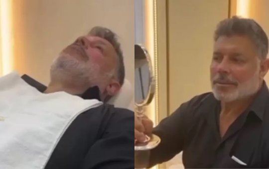 Alexandre Frota passa por harmonização facial e publica resultado na web; veja