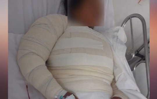 Mulher tem 50% do corpo queimado após ser atacada por água fervente no recôncavo