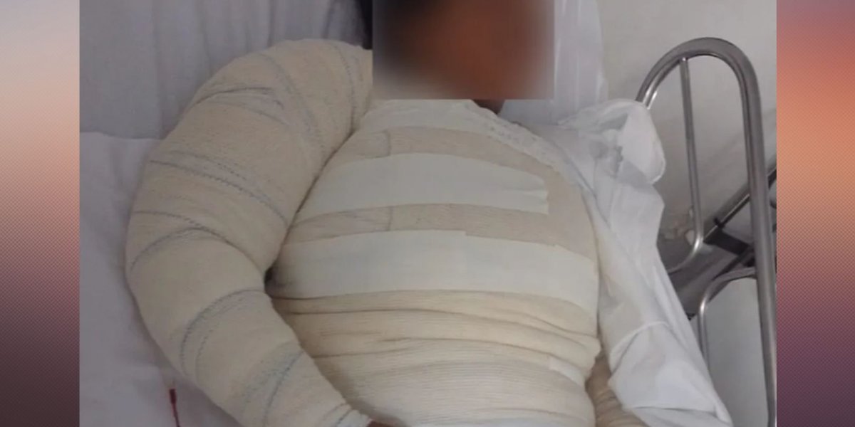 Mulher tem 50% do corpo queimado após ser atacada por água fervente no recôncavo