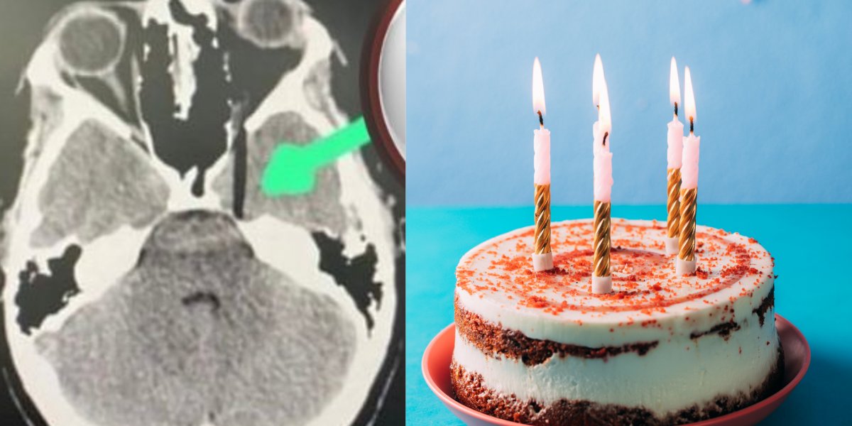 Criança perde olho após 'brincadeira' de empurrar o rosto no bolo de aniversário