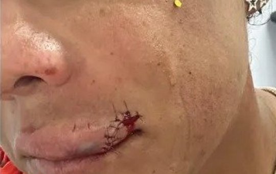 Mulher diz ter sido agredida com murro na boca em bloco puxado por Bell Marques