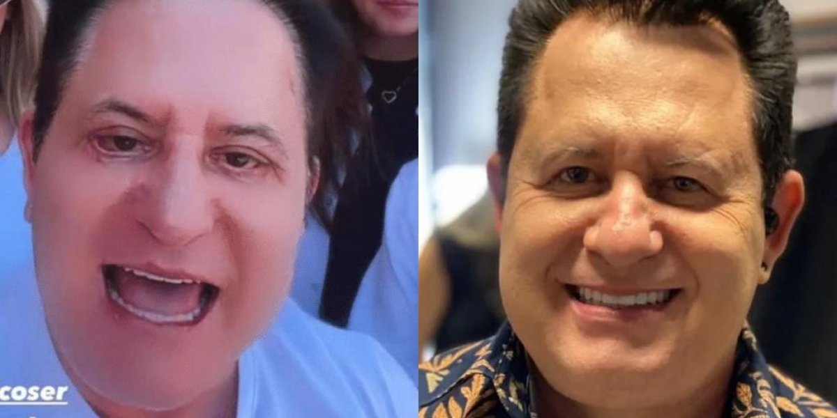 Marrone faz harmonização facial e divide opiniões