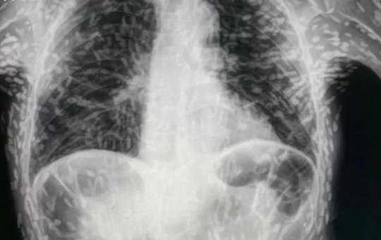Raio-x chocante mostra tórax de paciente repleto de ovos de tênia