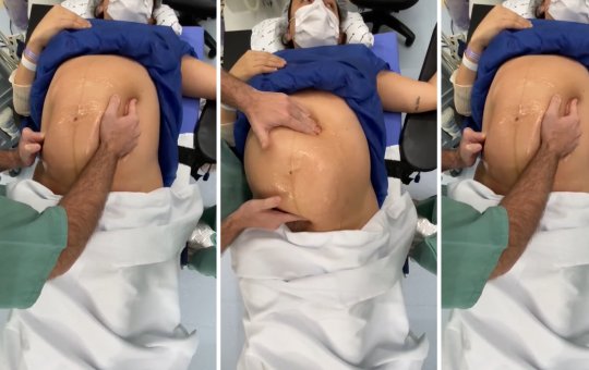 Viralizou! Médico vira bebê dentro do útero momentos antes do parto; Veja