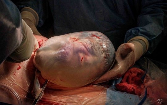 Em parto raro, bebê nasce empelicado; mulher dá à luz gêmeos em Salvador