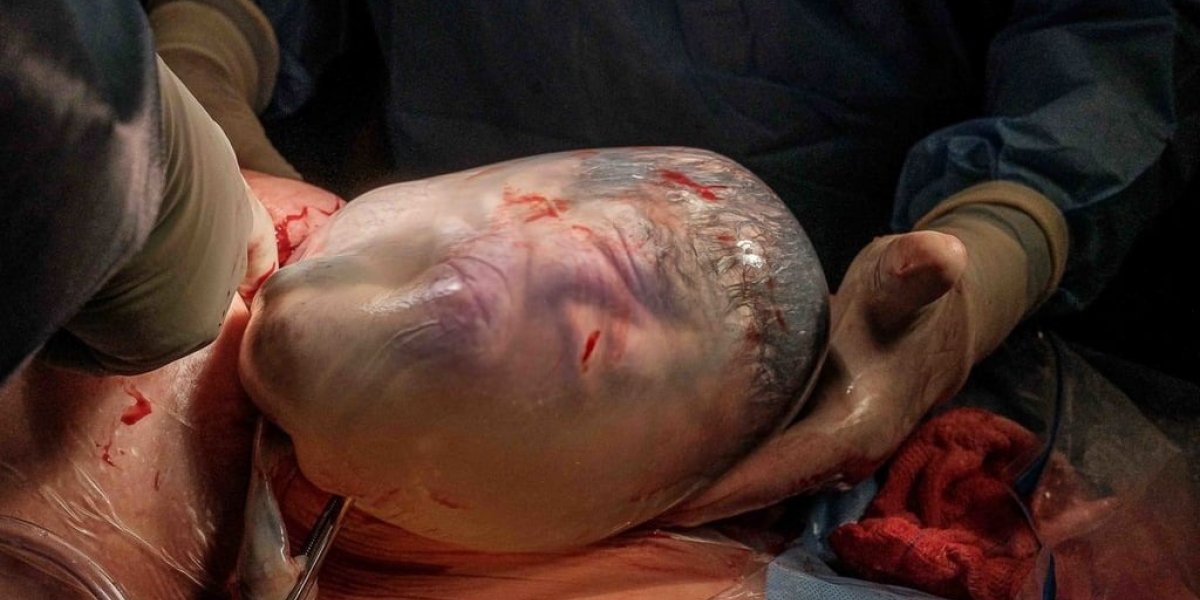 Em parto raro, bebê nasce empelicado; mulher dá à luz gêmeos em Salvador