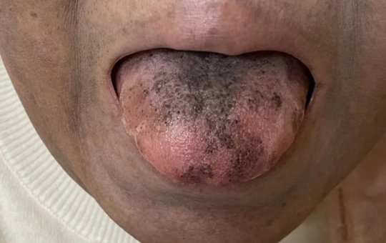 Mulher fica com língua peluda e preta após remédio; saiba o que aconteceu 