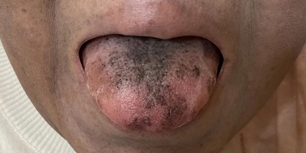 Mulher fica com língua peluda e preta após remédio; saiba o que aconteceu