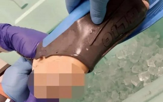 Tubarão arranca pé de turista em praia nos EUA; imagens impressionam