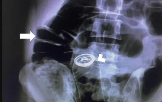 Homem passa por cirurgia para retirar desodorante do ânus