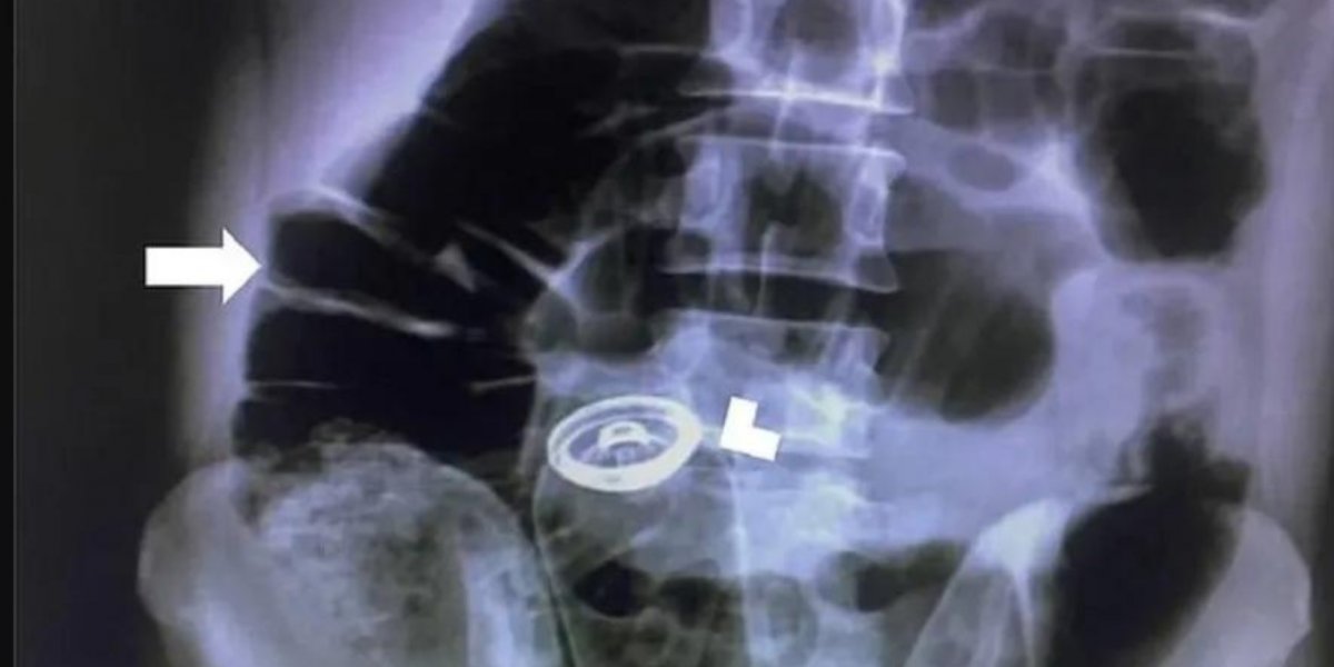 Homem passa por cirurgia para retirar desodorante do ânus