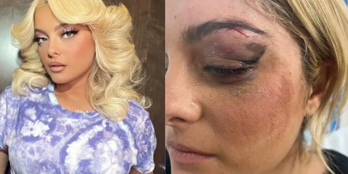 Bebe Rexha fica com hematomas no rosto após fã arremessar celular em show