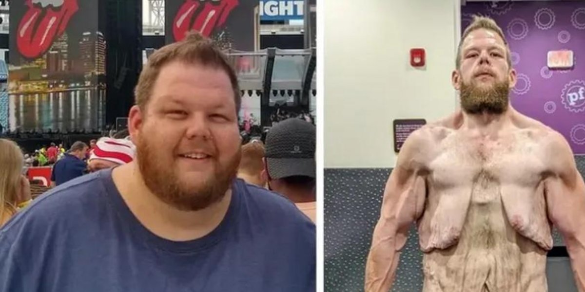 Homem perde quase 200kg e excesso de pele impressiona