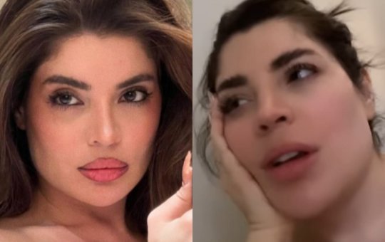 Gkay desabafa sobre harmonização facial: "Não tinha ninguém para avisar"