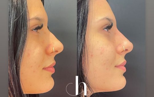 Ana Castela choca a internet ao mostrar o resultado de cirurgia estética