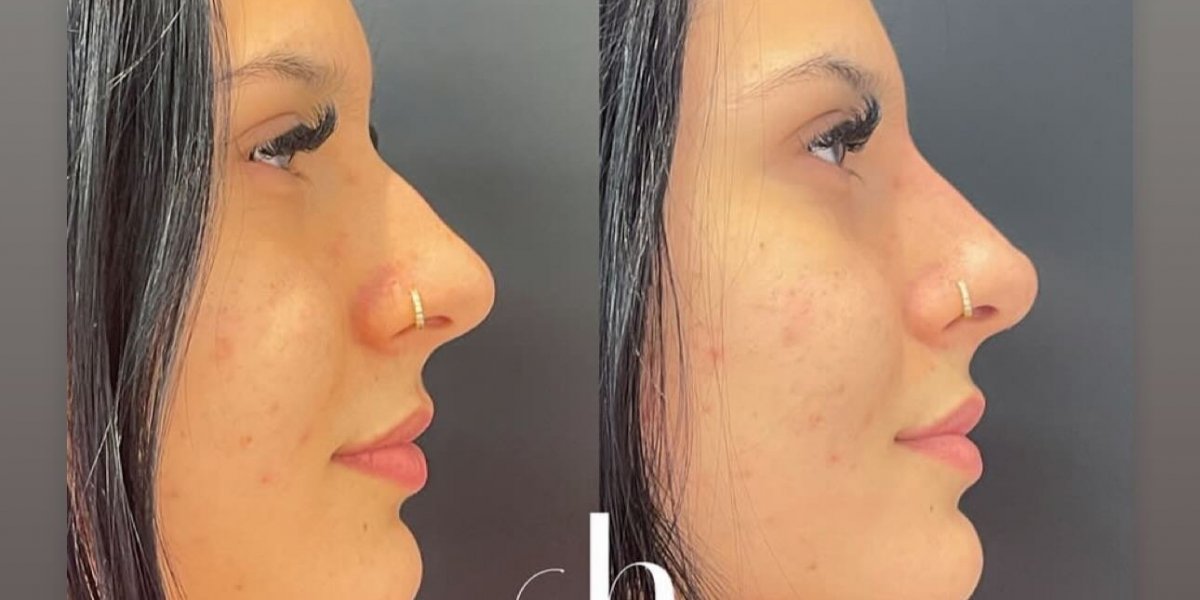 Ana Castela choca a internet ao mostrar o resultado de cirurgia estética