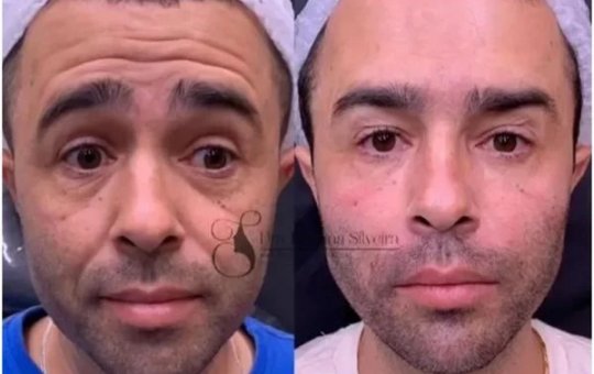 Motorista que atropelou Kayky Brito faz harmonização facial