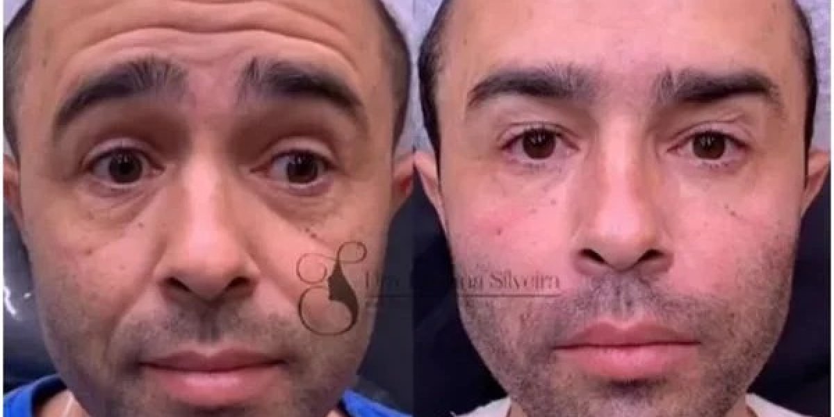 Motorista que atropelou Kayky Brito faz harmonização facial