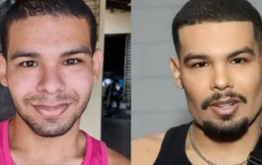 Vyni retruca críticas na web, após harmonização facial