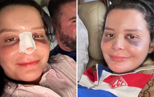 Maraisa reaparece nas redes sociais após acidente e mostra nariz fraturado