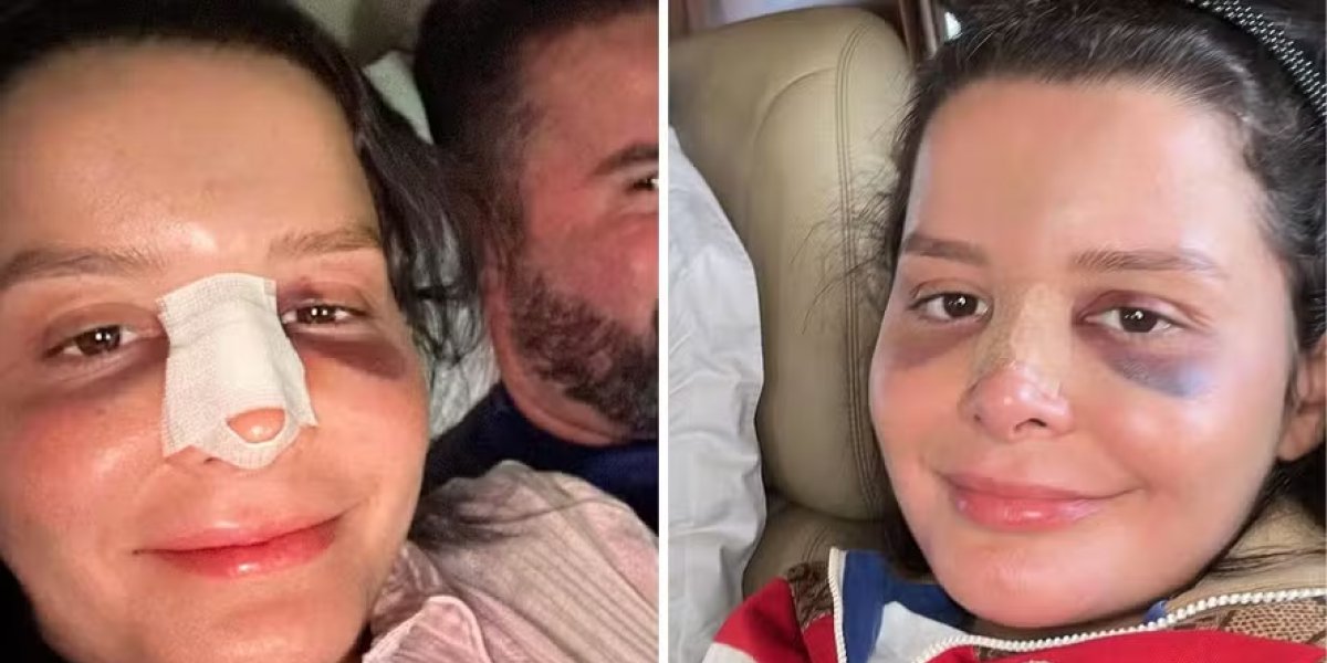 Maraisa reaparece nas redes sociais após acidente e mostra nariz fraturado