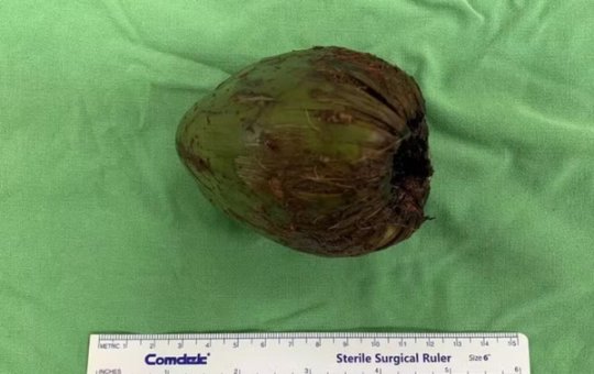 Já viu isso? Homem insere coco na região anal para estímulo sexual e é operado