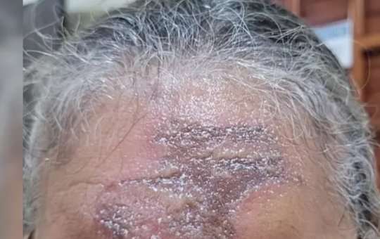 Fiéis tem queimadura após unção com óleo na igreja