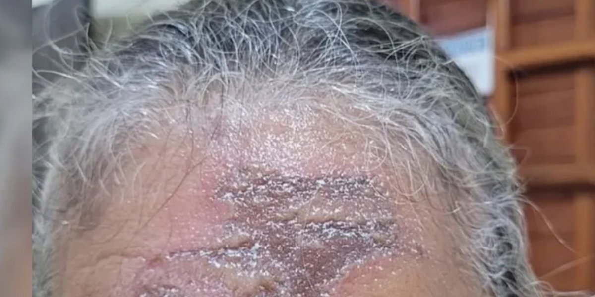 Fiéis tem queimadura após unção com óleo na igreja