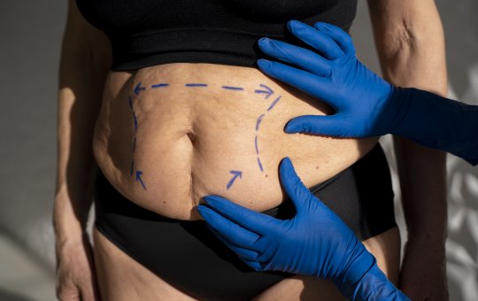 Entenda a rotina pós-operatória da cirurgia bariátrica