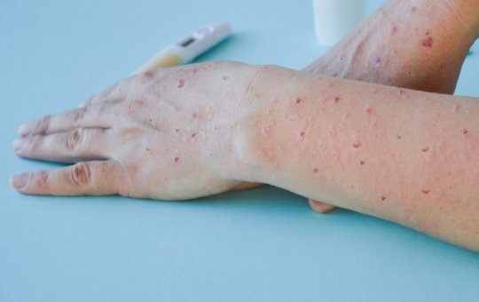 OMS alerta para nova variante da "varíola dos macacos"