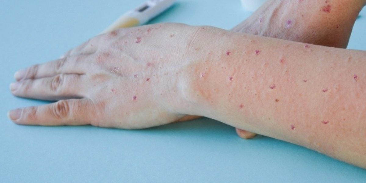 OMS alerta para nova variante da "varíola dos macacos"