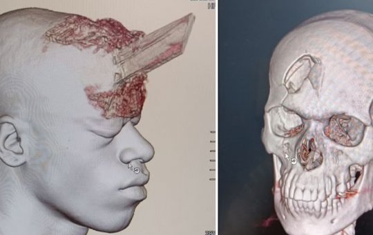 Pedreiro sobrevive a acidente fatal com estaca de madeira