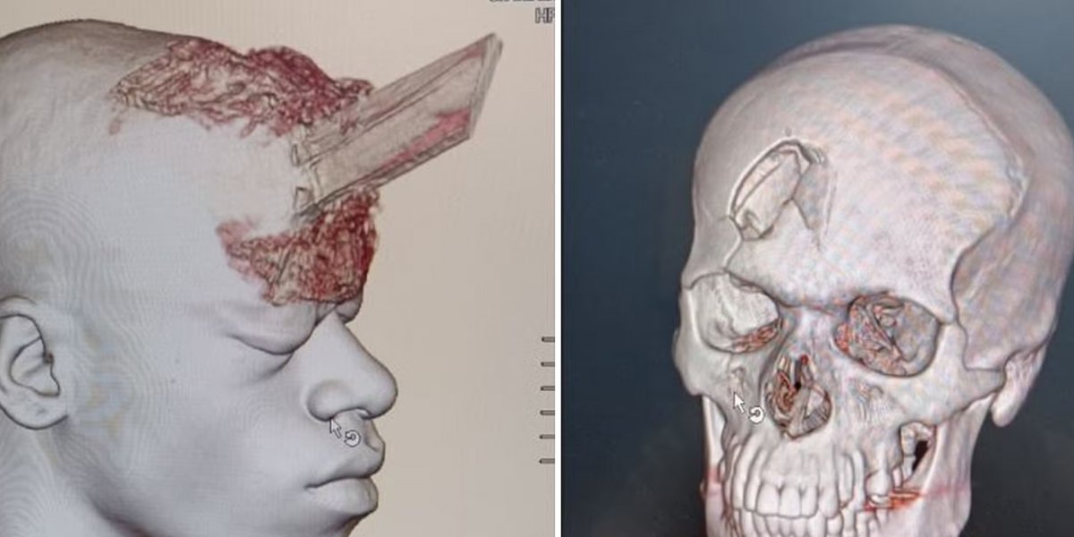 Pedreiro sobrevive a acidente fatal com estaca de madeira