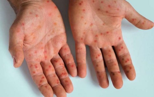 MPOX: Entenda os riscos da doença em alerta de saúde pública global