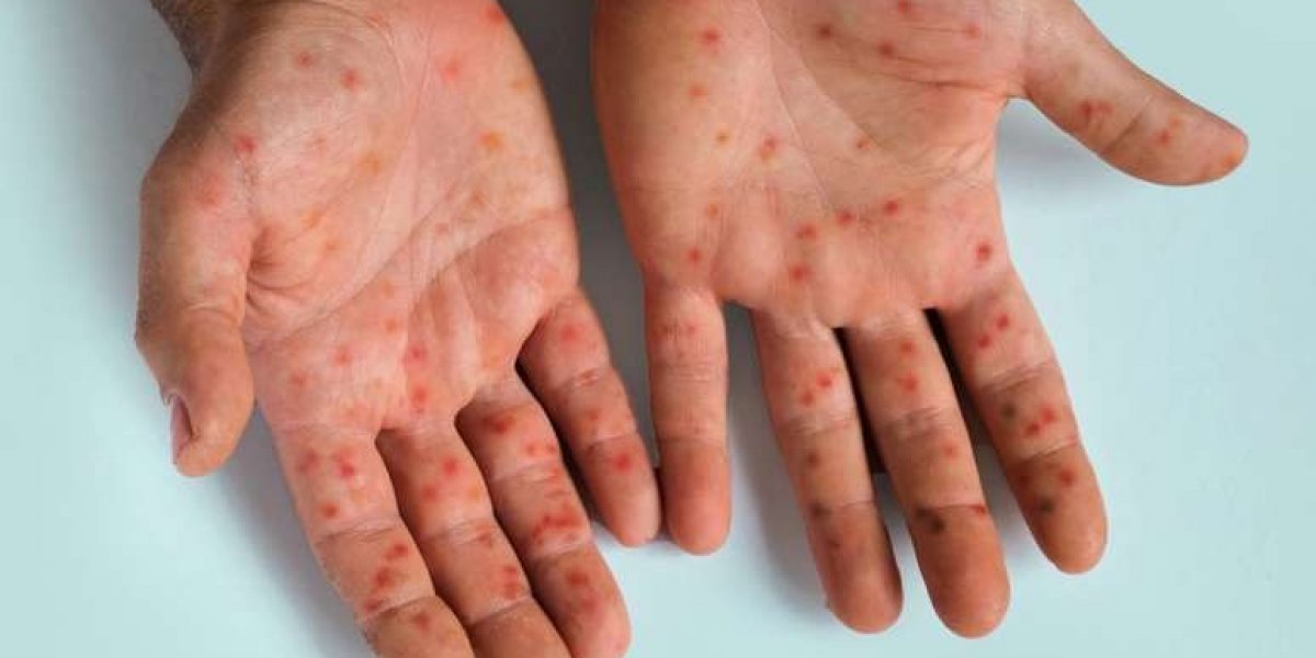 MPOX: Entenda os riscos da doença em alerta de saúde pública global