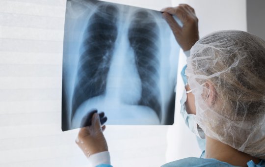 Estudo aponta crescimento do câncer de pulmão em 65% no Brasil até 2040; confira