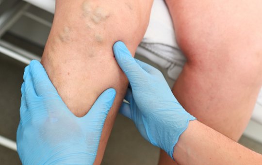 13 de Outubro: Dia Mundial da Trombose