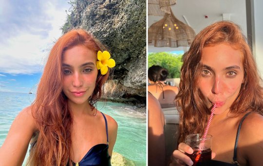 Vanessa Lopes desabafa sobre acne e lida com desafios emocionais