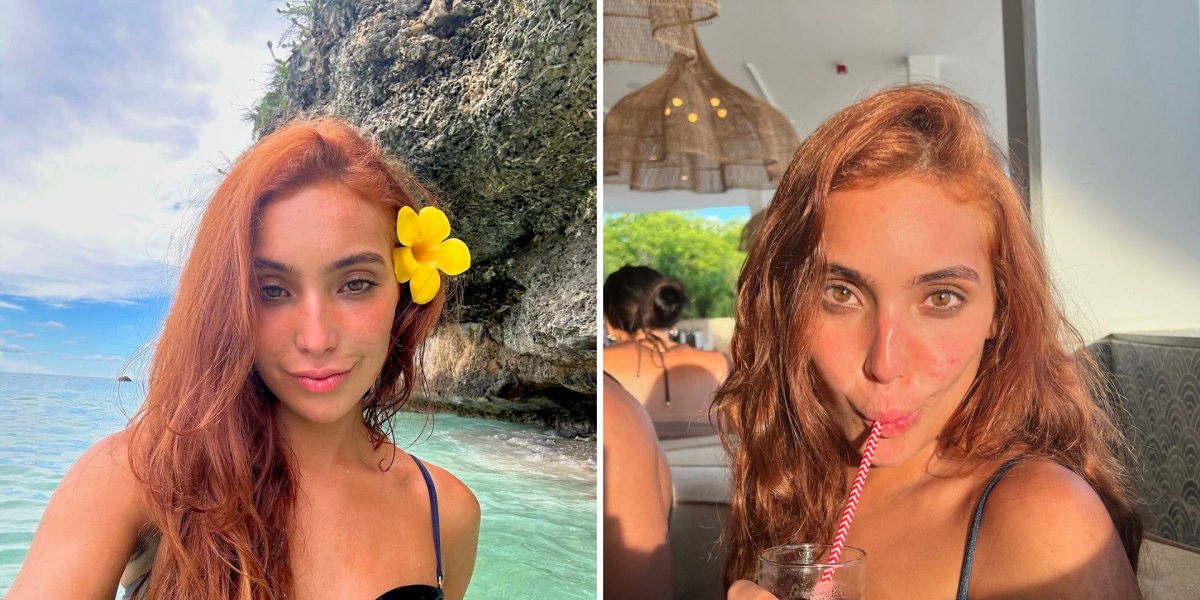 Vanessa Lopes desabafa sobre acne e lida com desafios emocionais