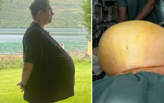 Homem descobre tumor de 27 kg após receber tratamento para obesidade