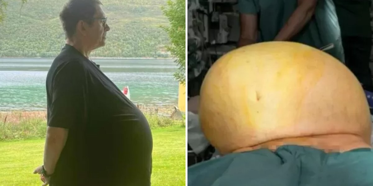 Homem descobre tumor de 27 kg após receber tratamento para obesidade