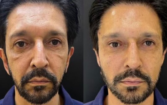 Ricardo Nunes (MDB) faz harmonização facial e investigação pode ser aberta; entenda