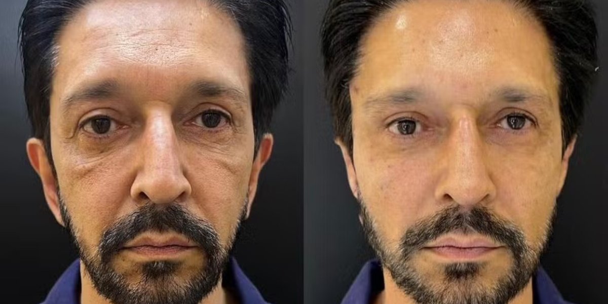 Ricardo Nunes (MDB) faz harmonização facial e investigação pode ser aberta; entenda