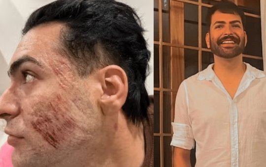 Mãe de empresário morto após fazer peeling de fenol pede indenização milionária